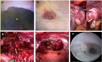 A neglected cervicovesical fistula diagnosed and repaired by combined hysteroscopy and laparoscopy: A case report and review of literature